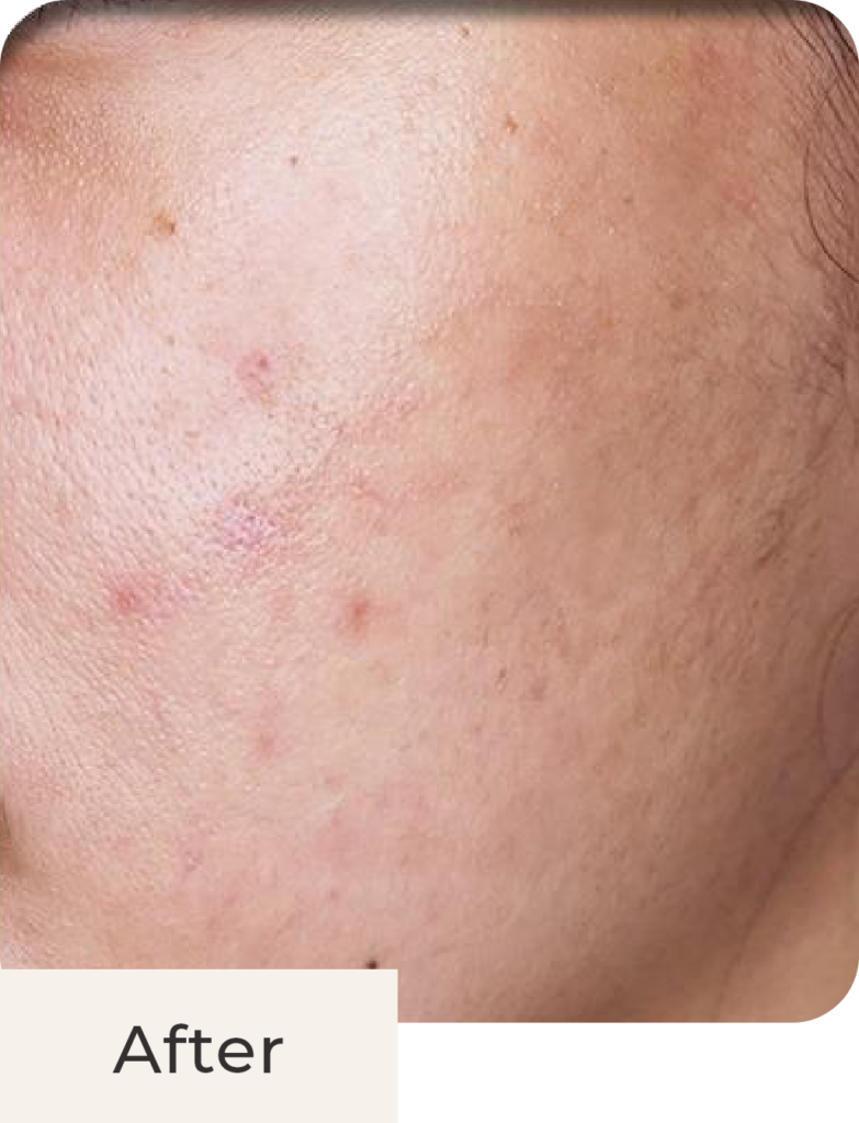 Wajah pasien after acne treatment di klinik kecantikan Kontura