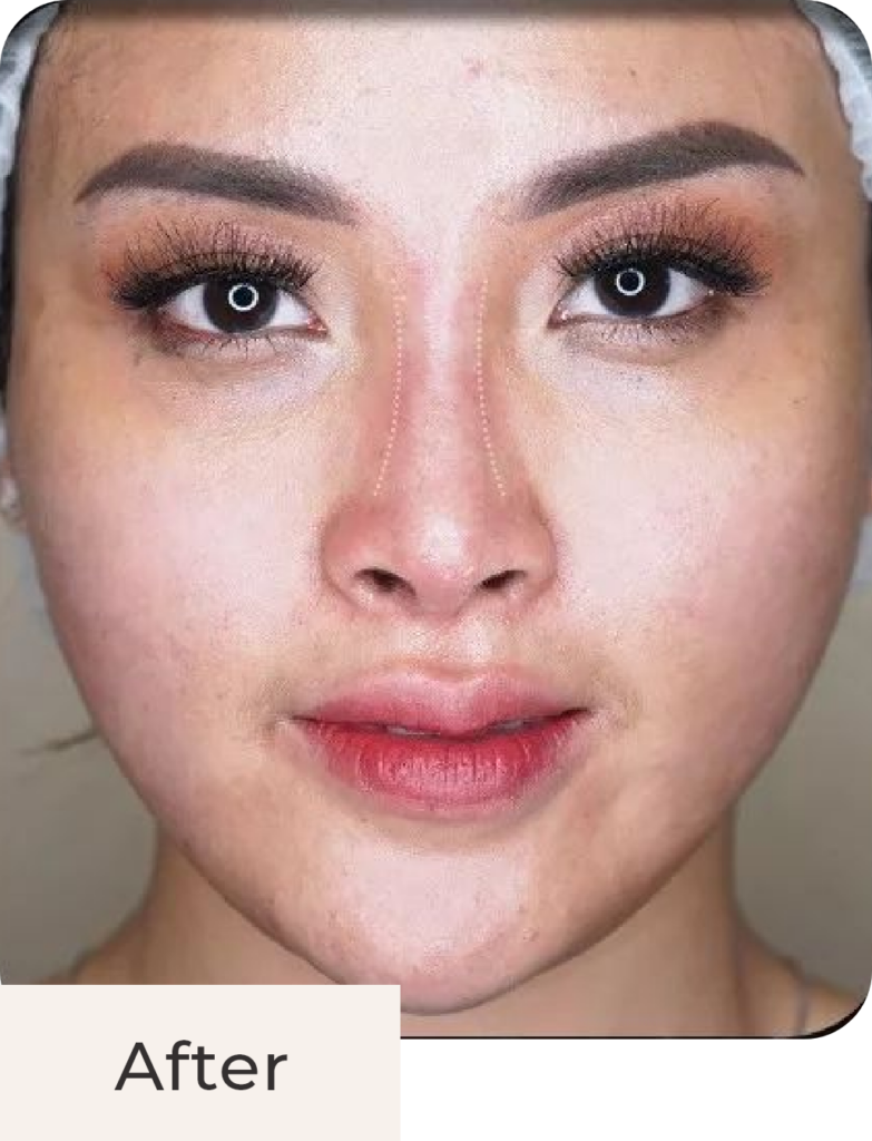 Foto pasien after treatment Threadlift Nose di Kontura