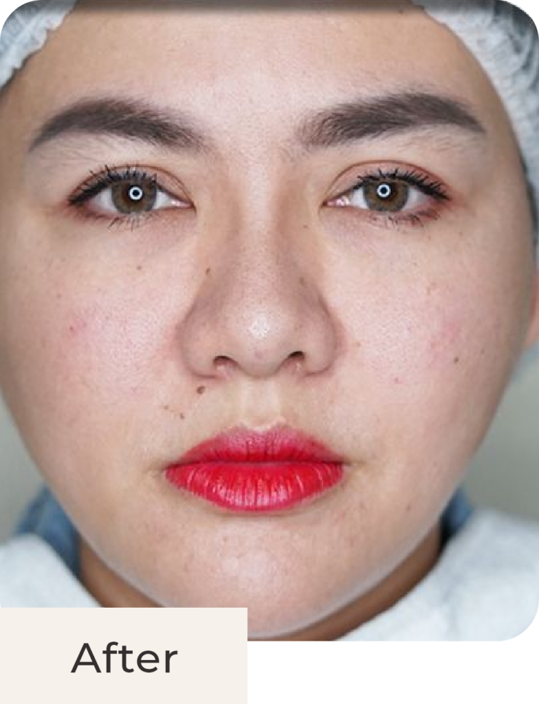 Tampak depan after treatment Threadlift Face & Double Chin