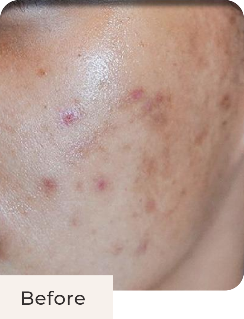 Wajah pasien before acne treatment di klinik kecantikan Kontura
