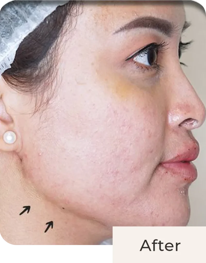 Wajah Vicky Shu after treatment Threadlift Face & Double Chin