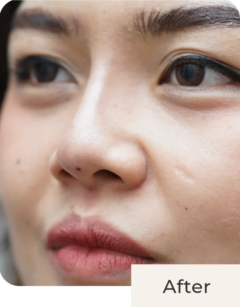 Foto pasien after treatment Threadlift Nose di Kontura