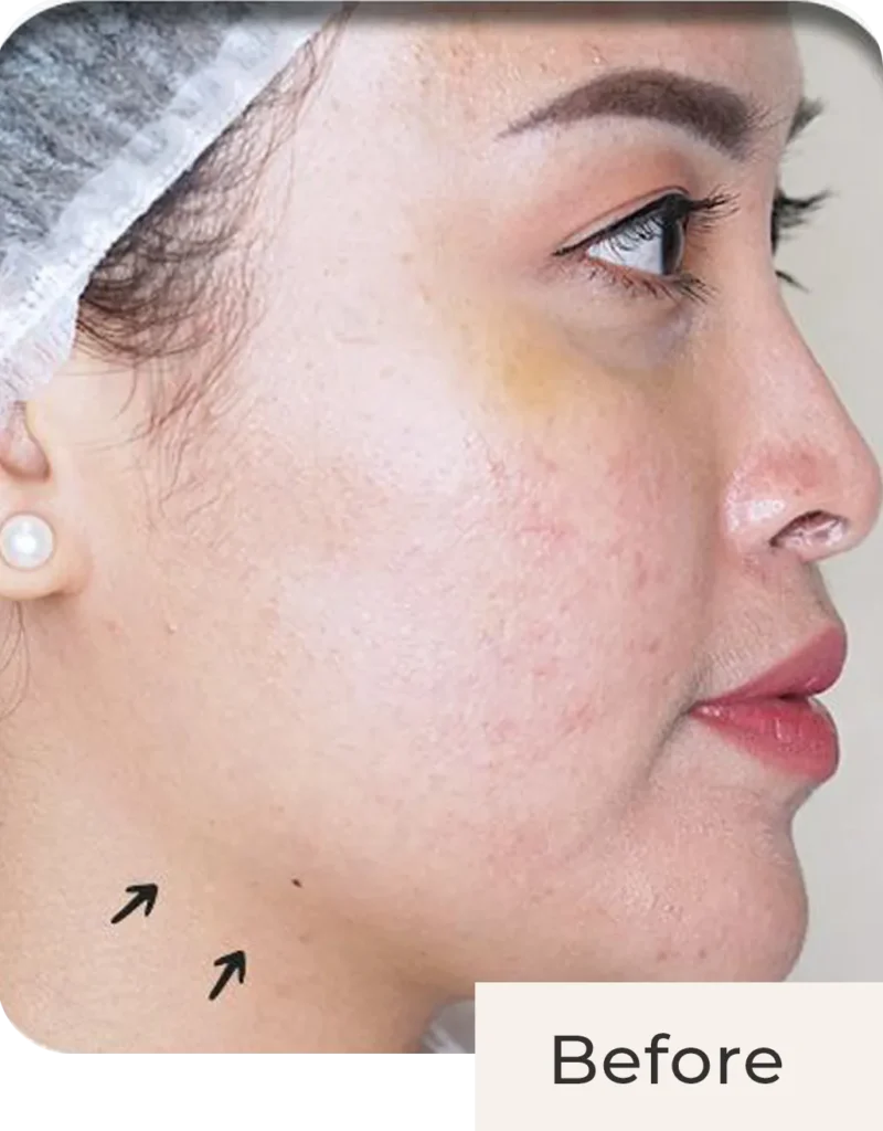 Wajah Vicky Shu before treatment Threadlift Face & Double Chin